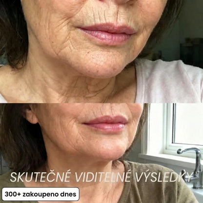 Vyplňující tyčinka s bio-kolagenem a PDRN